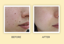 Say Goodbye to Moles and Warts with Mole and Warts Removal Treatment
