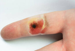 Causes, symptoms, treatments, and prevention of acid burn