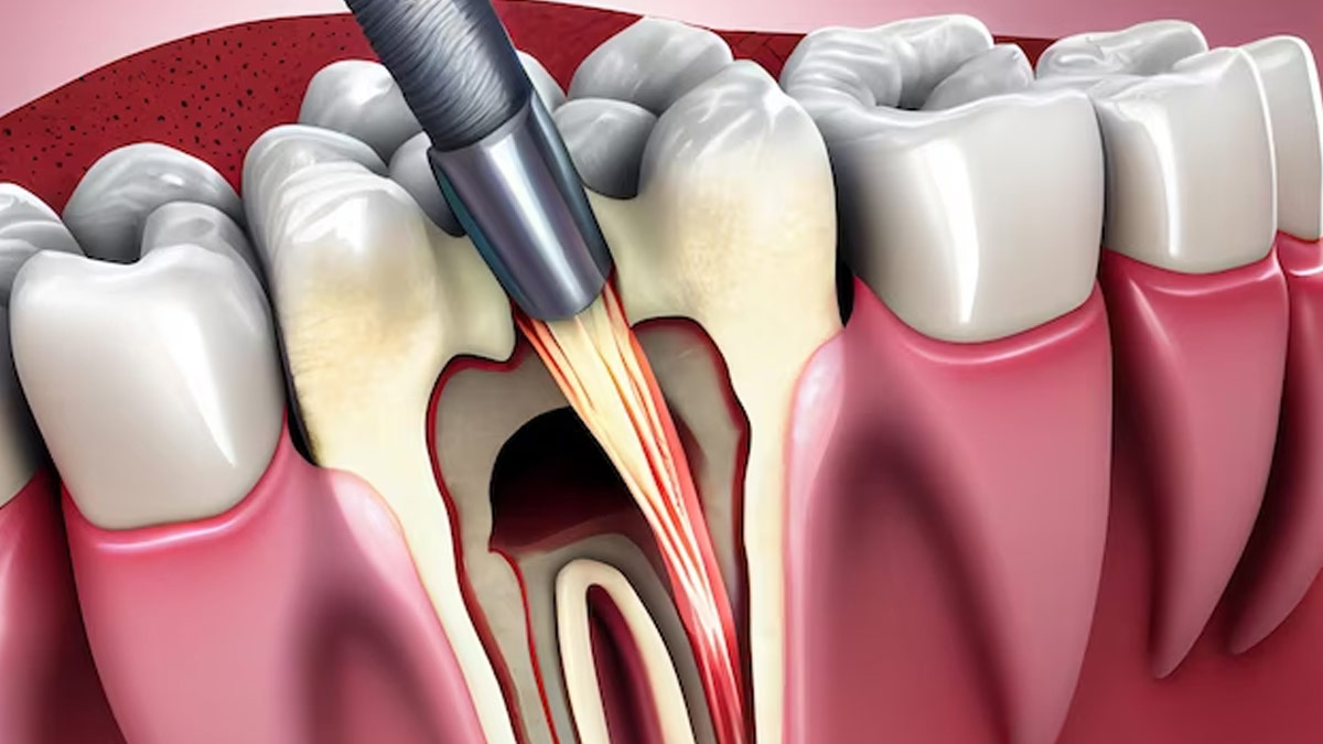 The Future of Dentistry: Innovative Approaches as Alternatives to Root Canals