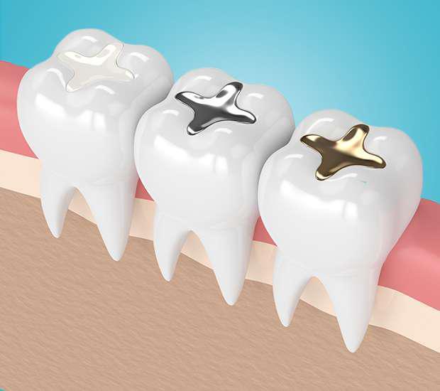 Achieving a Dazzling Smile: Finding the Best Composite Filling Dentists in Dubai