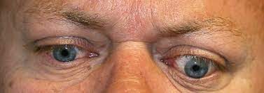 Understanding Lid Retraction: Causes and Treatment