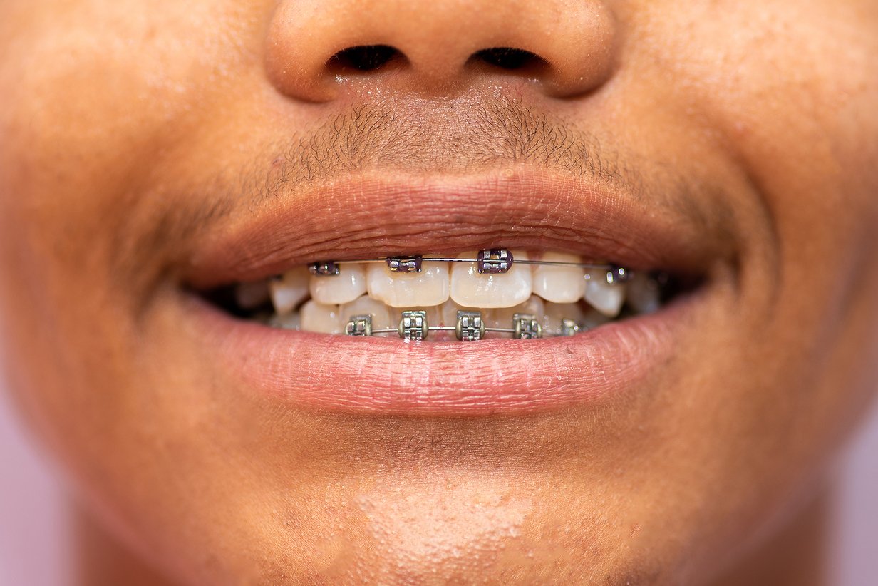 Tips for Maintaining Oral Hygiene with Metal Braces